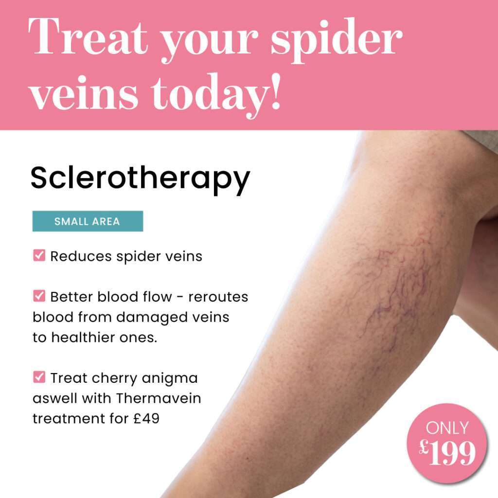 Sclerotherapy