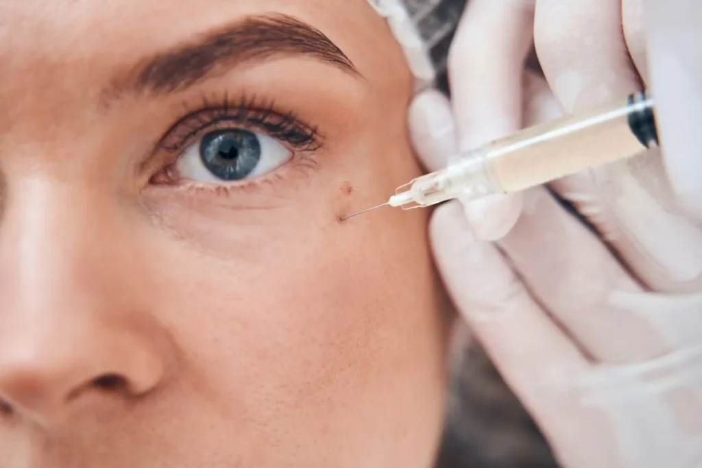under eye polynucleotide injections