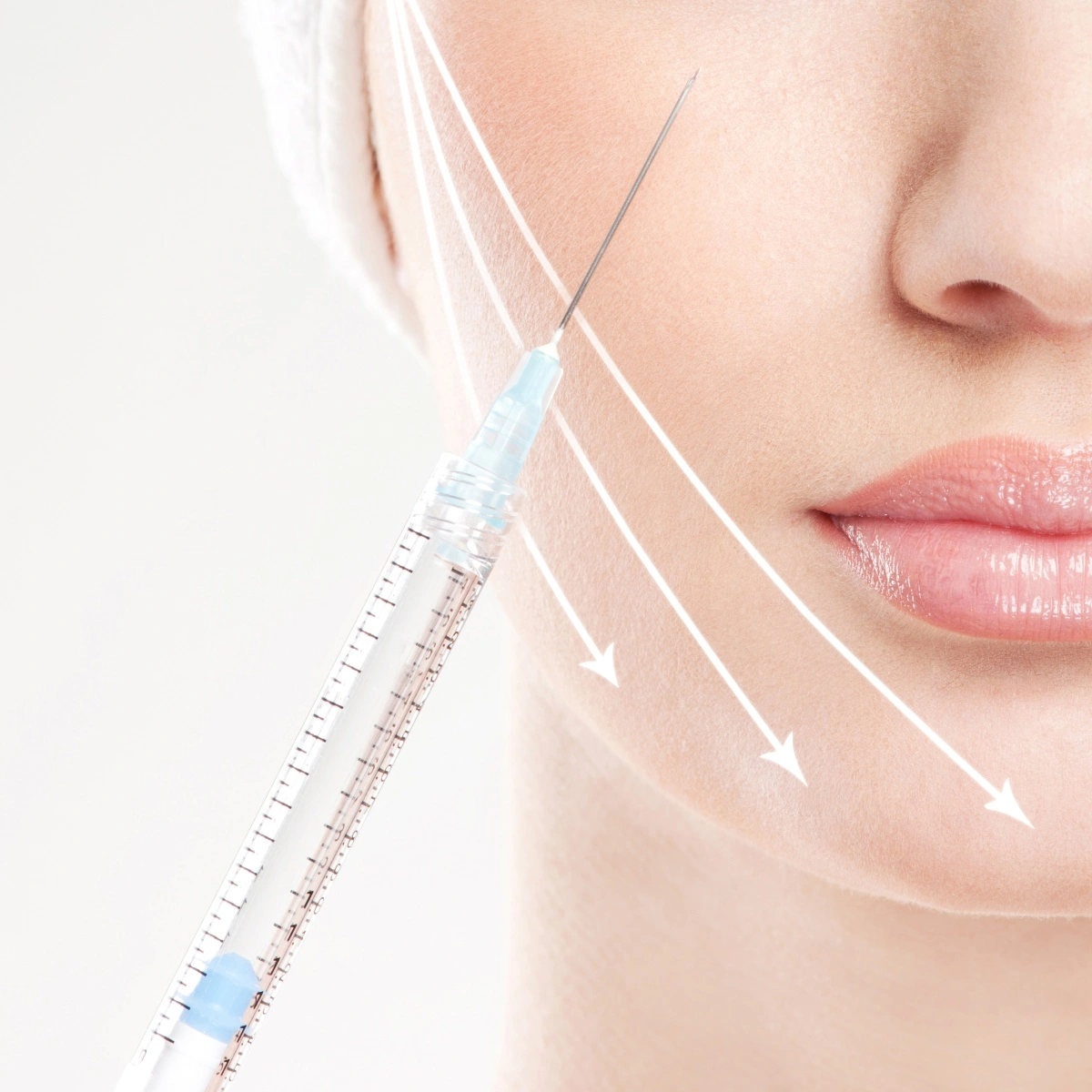 graphic depicting profhilo treatment