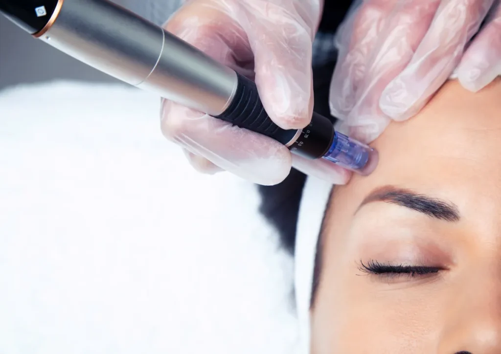 Dermapen microneedling treatment used alongside exosomes